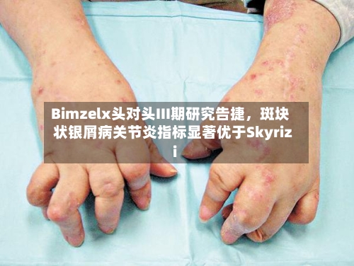 Bimzelx头对头III期研究告捷,斑块状银屑病关节炎指标显著优于Skyrizi